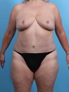 Breast Lift/Reduction w/o Implants - Case 27480 - After