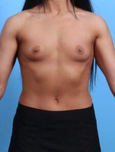 Breast Augmentation - Case 27507 - Before