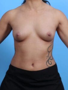 Breast Augmentation - Case 27523 - Before