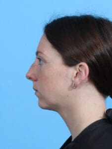 Chin Implant - Case 27550 - Before