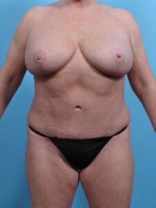 Breast Lift/Reduction with Implants - Case 27620 - After