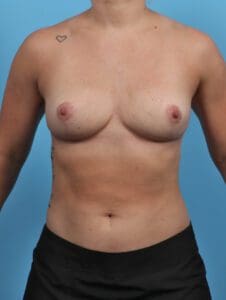 Breast Implant Removal - Case 27655 - After
