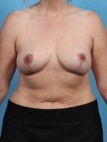Breast Implant Removal - Case 27671 - After