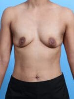 Breast Augmentation - Case 27697 - Before
