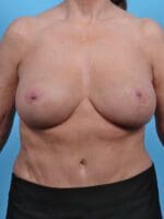 Breast Lift/Reduction w/o Implants - Case 27732 - After