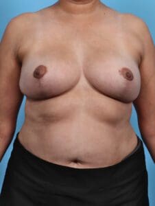 Breast Lift/Reduction w/o Implants - Case 27793 - After