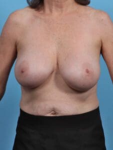 Breast Implant Revision - Case 27899 - After