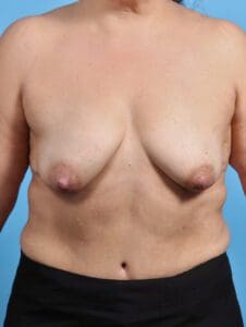 Breast Lift/Reduction with Implants - Case 27923 - Before
