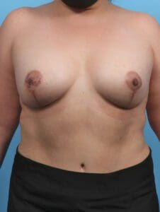 Breast Lift/Reduction with Implants - Case 27923 - After