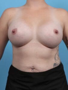 Breast Augmentation - Case 27949 - After