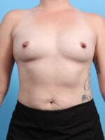 Breast Augmentation - Case 27949 - Before
