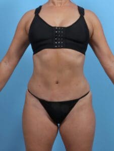 Tummy Tuck - Case 27957 - After