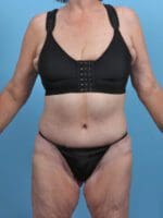 Tummy Tuck - Case 27973 - After