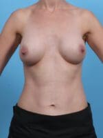 Breast Augmentation - Case 28059 - After