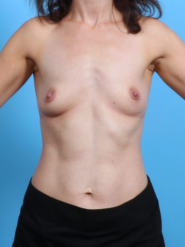 Breast Augmentation - Case 28059 - Before