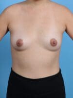 Breast Augmentation - Case 28157 - Before