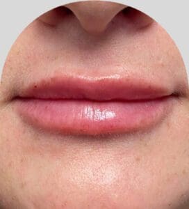 Lip Fillers - Case 28174 - After