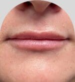 Lip Fillers - Case 28174 - Before