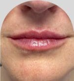 Lip Fillers - Case 28178 - After