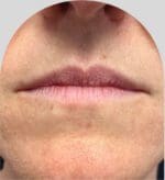 Lip Fillers - Case 28178 - Before