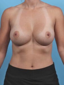 Breast Augmentation - Case 28255 - After