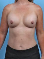 Breast Augmentation - Case 28271 - After