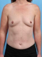 Breast Augmentation - Case 28271 - Before