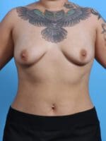Breast Augmentation - Case 28287 - Before