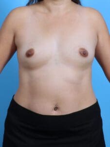 Breast Augmentation - Case 28303 - Before