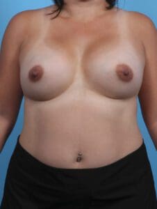 Breast Augmentation - Case 28303 - After