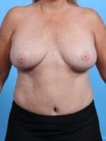 Breast Implant Revision - Case 28311 - Before