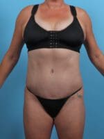 Tummy Tuck - Case 28329 - After