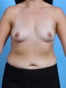 Breast Augmentation - Case 28340 - Before