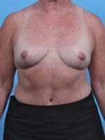 Breast Implant Removal - Case 28356 - After
