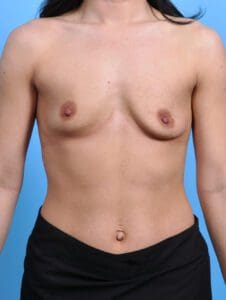 Breast Lift/Reduction with Implants - Case 28404 - Before