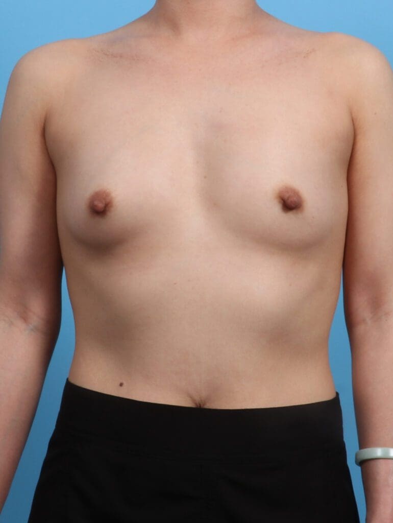 Breast Augmentation - Case 28420 - Before