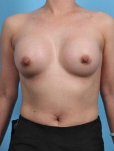Breast Augmentation - Case 28420 - After