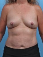 Breast Implant Removal - Case 28428 - After