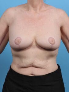 Breast Lift/Reduction w/o Implants - Case 28476 - After
