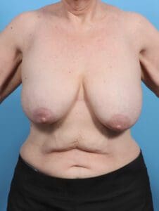 Breast Lift/Reduction w/o Implants - Case 28476 - Before