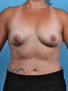 Breast Implant Removal - Case 28484 - After