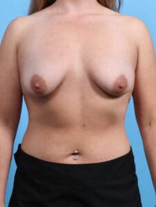 Breast Lift/Reduction with Implants - Case 28500 - Before