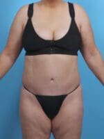 Tummy Tuck - Case 28518 - After