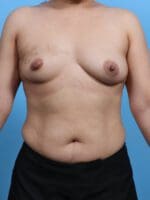 Breast Augmentation - Case 28534 - Before