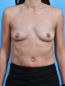Breast Augmentation - Case 28575 - Before