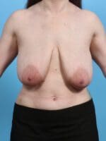 Breast Lift/Reduction w/o Implants - Case 28593 - Before