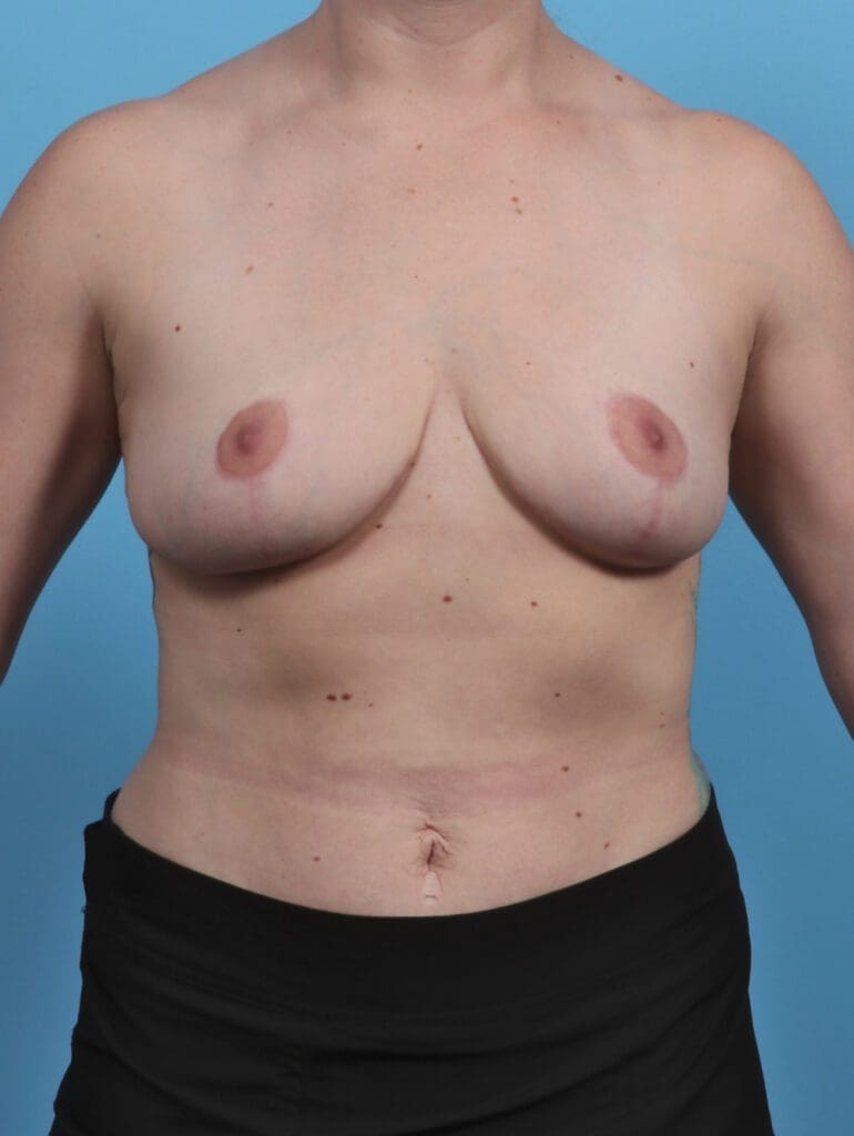 Breast Lift/Reduction w/o Implants - Case 28593 - After
