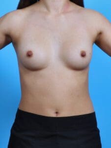 Breast Augmentation - Case 28611 - Before