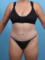 Tummy Tuck - Case 28697 - After