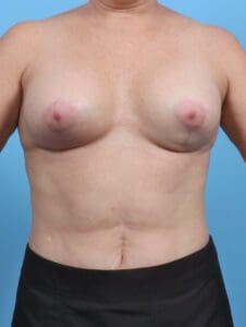 Breast Implant Revision - Case 28707 - After
